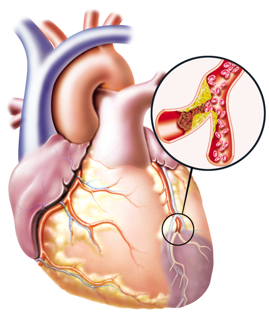 Immagine di un cuore con flusso sanguigno compromesso e blocco di un vaso sanguigno.